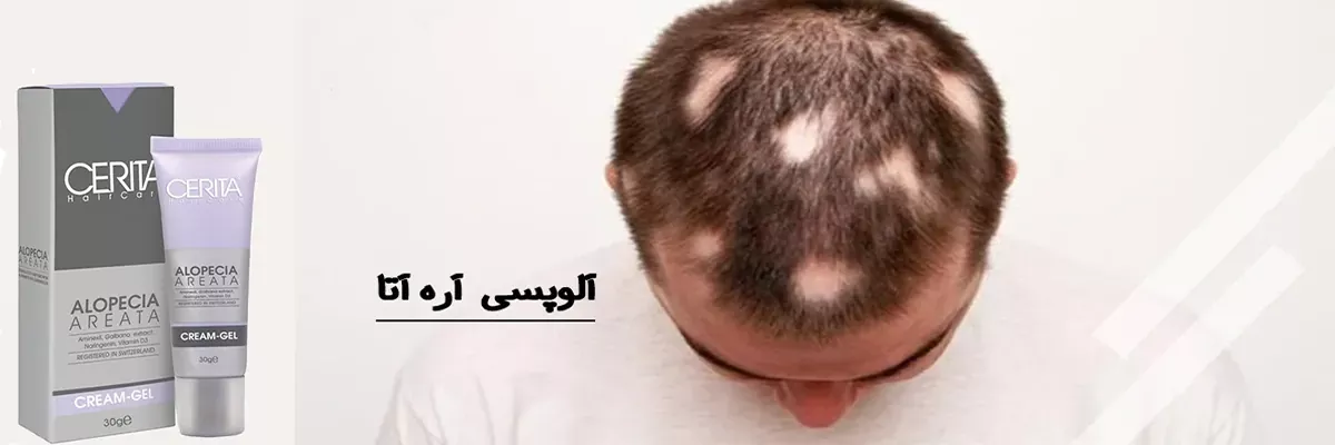 کرم ژل ضد ریزش سکه ای سریتا مدل Alopcia Areata | سان ماری