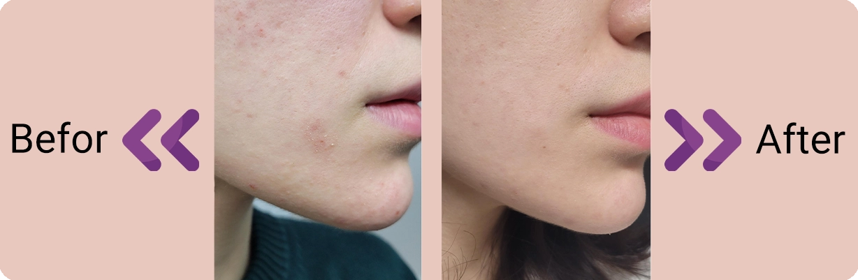 سرم لایه بردار لاکتیک اسید اوردینری Lactic Acid 5% HA | سان ماری