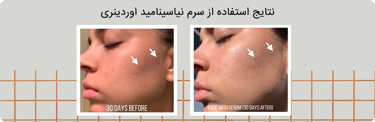 قیمت سرم ضد جوش نیاسینامید 10% + زینک 1% اوردینری | سان ماری