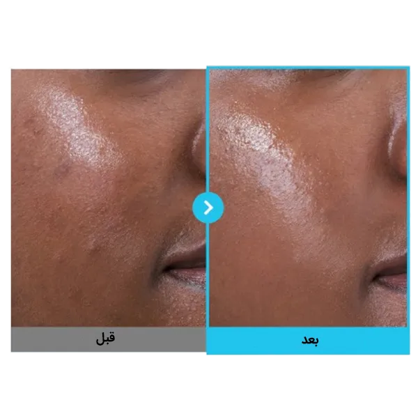 نتایج استفاده از سرم رتینول آبی نامبوزین اصل و اورجینال | سان ماری
