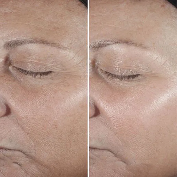نتایج استفاده از سرم ضد چروک smart clinical repair کلینیک اصل و اورجینال | سان ماری